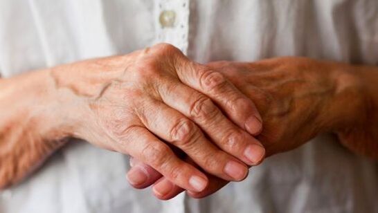 آرتریت روماتوئید به عنوان یک علت درد در مفاصل انگشتان دست