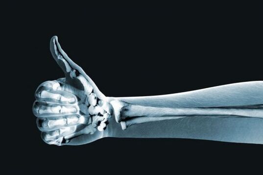 اشعه ایکس برای تشخیص درد در مفاصل انگشتان دست