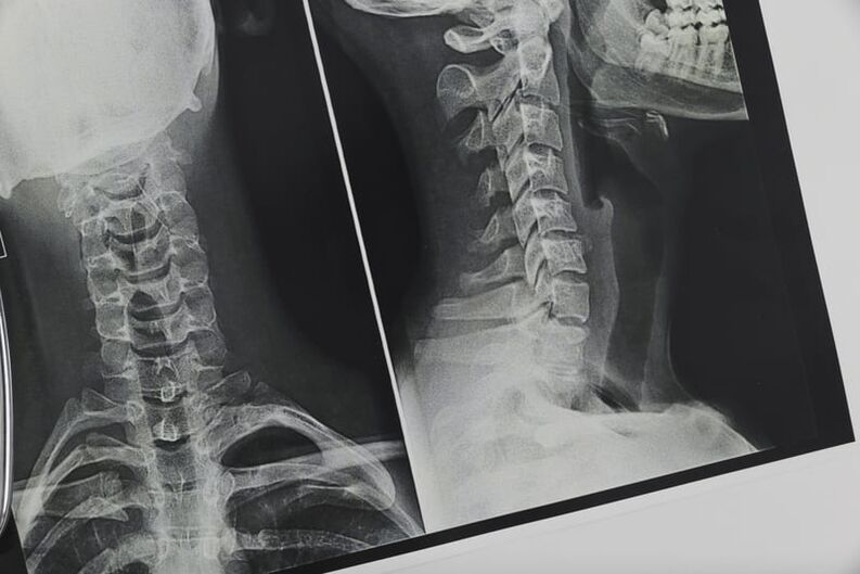 عکسبرداری با اشعه ایکس از ستون فقرات گردنی تحت تأثیر پوکی استخوان