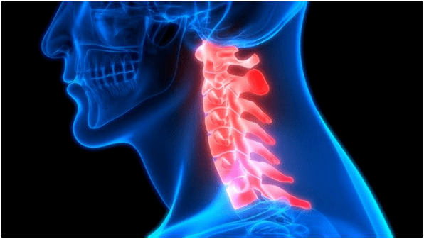 گردن درد منجر به کمردرد می شود