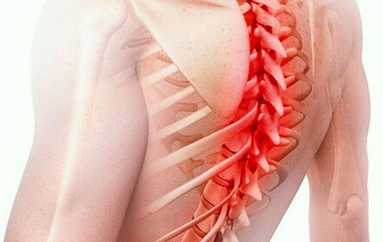 پوکی استخوان ستون فقرات قفسه سینه