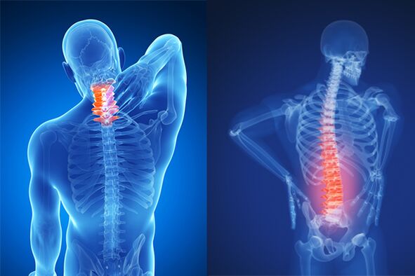 استئوکندروز ستون فقرات گردنی و کمری